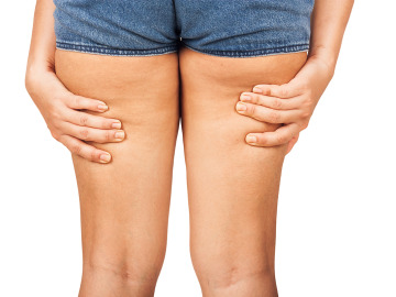 Unas piernas con celilitis Unas piernas con celilitis